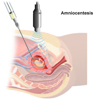 ¿El fin de la amniocentesis?