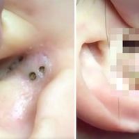 Hay MUCHA gente enganchada a esta extracción de un punto negro en la oreja y nos cuesta entenderlo