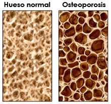 Osteoporosis a los treinta