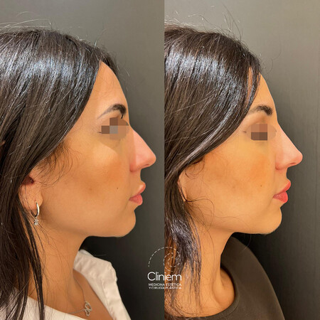 Post Dra Alba Rhinomodeling 2