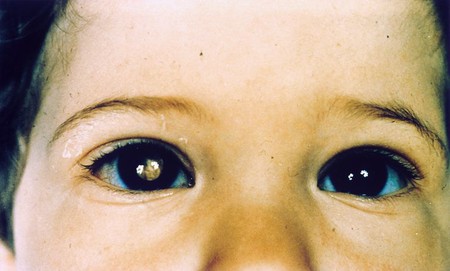 Así es cómo la cámara de tu smartphone puede detectar una forma de cáncer en tus ojos