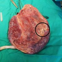 La vida se abre paso: increíble imagen de una placenta con un DIU anticonceptivo