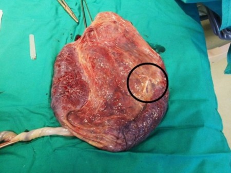 La vida se abre paso: increíble imagen de una placenta con un DIU anticonceptivo