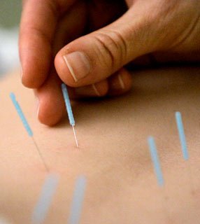 ¿Se ha demostrado que la acupuntura funciona y no me había enterado?