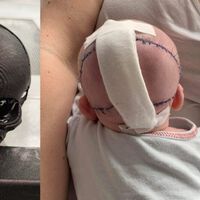 Crean un cráneo impreso en 3D para salvar la vida de un bebé que nació sin una parte del hueso 