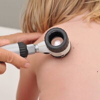 Lunares en la piel de los niños: qué características tienen y cuándo consultar con el dermatólogo