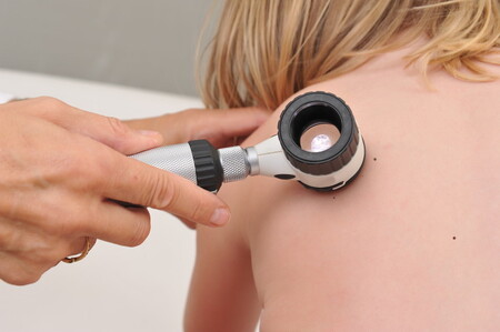 Lunares en la piel de los niños: qué características tienen y cuándo consultar con el dermatólogo