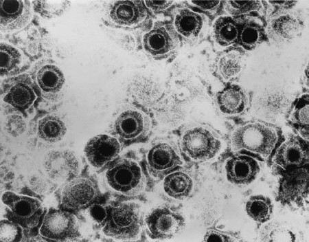La gente tratada por infección de herpes podría tener menos riesgo de desarrollar Alzheimer