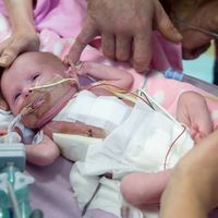 La bebé británica que nació con el corazón fuera de su cuerpo, ya ha sido dada de alta