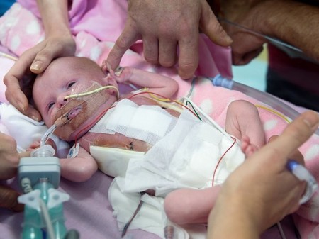 La bebé británica que nació con el corazón fuera de su cuerpo, ya ha sido dada de alta