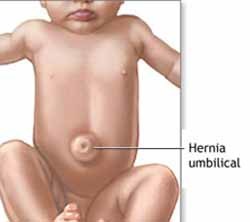 La hernia umbilical