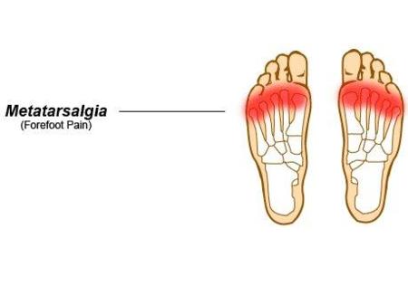 Metatarsalgia por sobrecarga, un problema frecuente en corredores