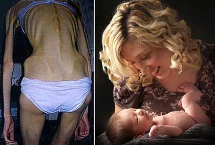 Tras 8 años de lucha contra la anorexia ha sido madre