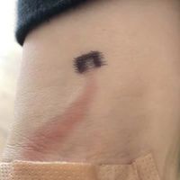 "Las heridas pueden terminar en sepsis", alerta una madre que salvó la vida de su hijo al descubrir una mancha roja en su brazo