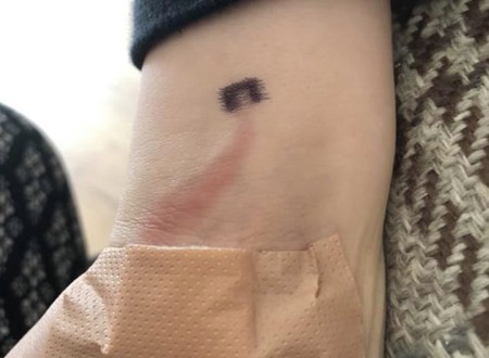 "Las heridas pueden terminar en sepsis", alerta una madre que salvó la vida de su hijo al descubrir una mancha roja en su brazo