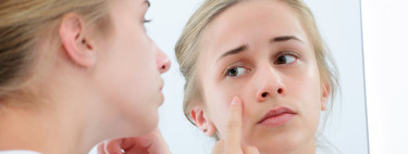 Acné en la adolescencia: por qué salen granos y qué cuidados hay que tener