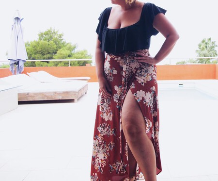 lipedema
