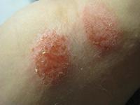 La lejía diluida alivia el eczema de los niños
