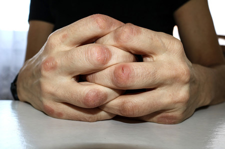 Artritis psoriásica: qué es, cuáles son sus causas y cómo el ejercicio físico puede ayudar en esta patología