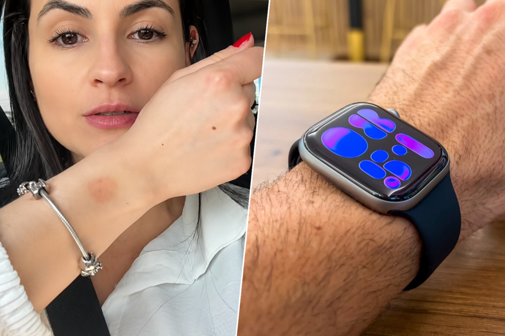 Llevamos el Apple Watch tantas horas que ya hay un nombre para el problema que puede provocar en la piel: watch rot 