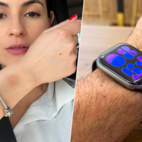 "Es un problema frecuente". Los dermatólogos avisan del problema silencioso de los Apple Watch en la piel