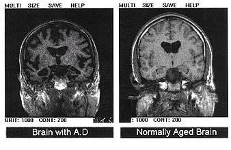 El Alzheimer puede ser el resultado de un nuevo tipo de diabetes