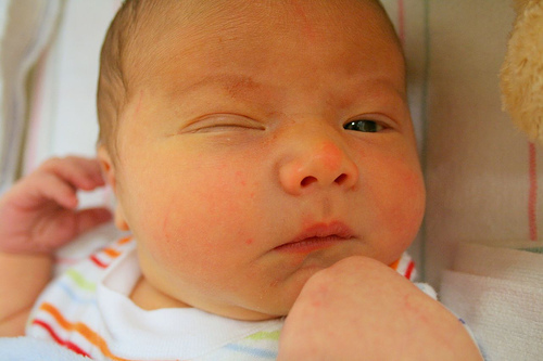 lagaña verde en bebe recien nacido
