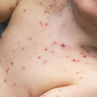 Un bebé de 11 meses sufre un derrame cerebral causado por la varicela: la importancia de las vacunas