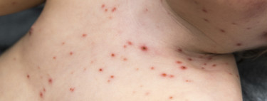 Un bebé de 11 meses sufre un derrame cerebral causado por la varicela: la importancia de las vacunas