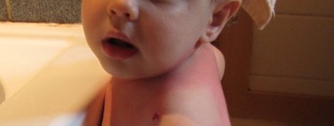 Alergias en los bebés: Urticaria y angioedema
