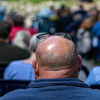 Hacia una España sin calvos: así están creciendo los injertos capilares 