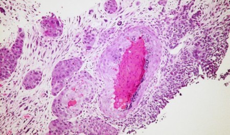 Cuba tiene una prometedora vacuna contra el cáncer de pulmón, y Estados Unidos la quiere