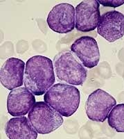 Los niños curados de leucemia tienen más riesgo de sufrir otro cáncer en el futuro