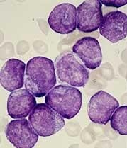 Los niños curados de leucemia tienen más riesgo de sufrir otro cáncer en el futuro