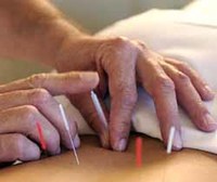 La acupuntura podría ayudar a lograr el embarazo en la fertilización in vitro