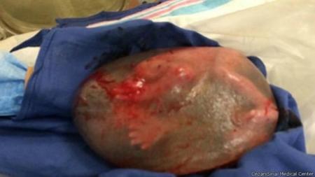 150225115432 Placenta 624x351 Cedarssinaimedicalcenter