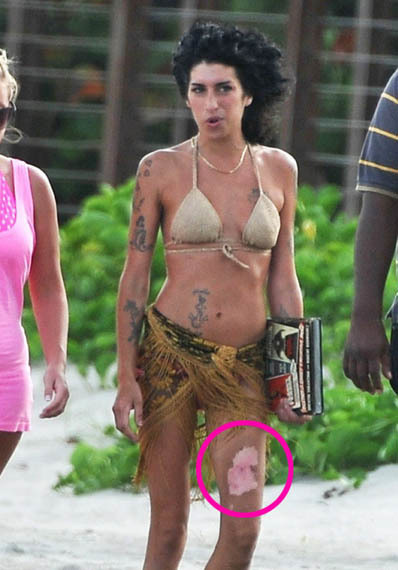 Amy Winehouse se quema una pierna mientras cocina
