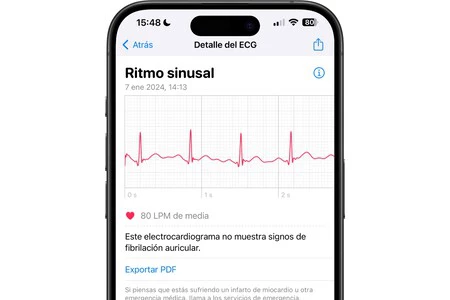 洞調律を伴う心電図の例、すべてがうまくいけば結果が出るはずです