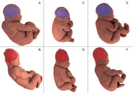 Así se deforma la cabeza del bebé durante el parto para facilitar su paso por la pelvis materna