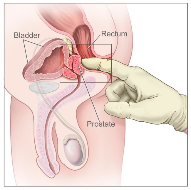 Qu es el masaje de prstata y cmo se hace. Por qu es otra manera de  proporcionar placer a un hombre.