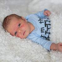 Tratar las manchas de 'vino de Oporto' es más rápido y eficaz gracias a este tratamiento pionero del Hospital Sant Joan de Déu