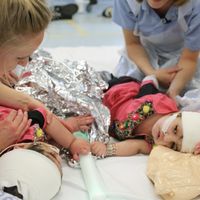 Dos hermanas siamesas unidas por la cabeza fueron separadas con éxito gracias a una donación y ya han recibido el alta