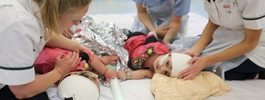 Dos hermanas siamesas unidas por la cabeza fueron separadas con éxito gracias a una donación y ya han recibido el alta