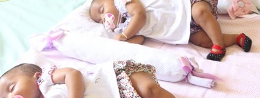 Separan exitosamente a unas siamesas unidas por el pecho y el abdomen, gracias al trabajo en equipo de 78 profesionales