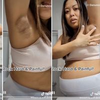 Una madre de trillizos enseña un dolorosa congestión mamaria en las axilas tras dar a luz 