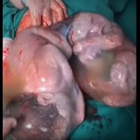 Un raro e impresionante parto velado de gemelas en Brasil: cada una nace dentro de su bolsa amniótica intacta 