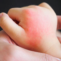 Ivy, la niña con alergia al agua a la que hacen daño sus propias lágrimas