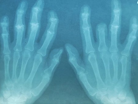 Algunos ejercicios para mejorar la artritis