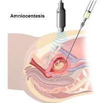 Test de embarazo que evita la mitad de las amniocentesis que se realizan