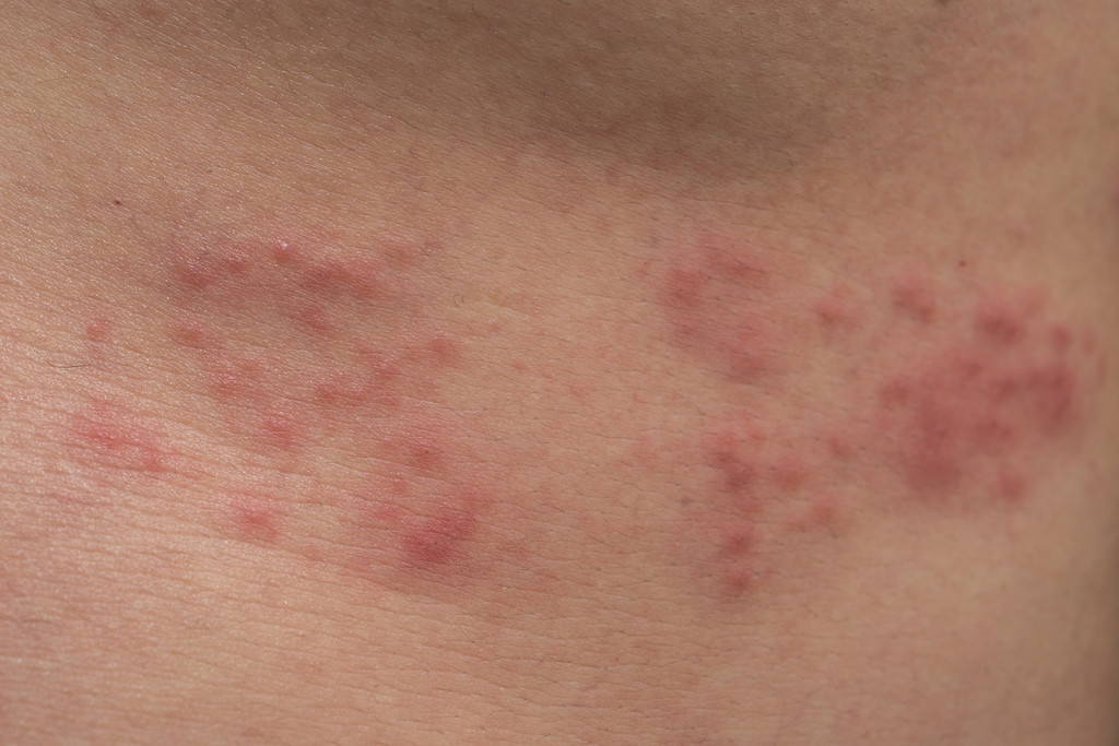 Todo lo que tienes que saber sobre el herpes causas s ntomas y